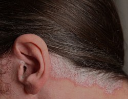 Psoriasi
