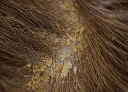 Dermatite seborroica