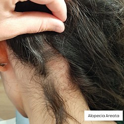 Alopecia Areata