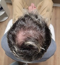 Alopecia Androgenetica